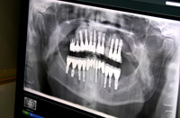 X-ray showing my 17 implants (now 18) - 2009